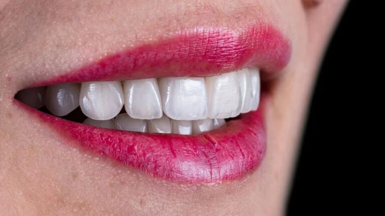 Elevate Your Smile: Porcelain Veneers vs. Dental Bonding