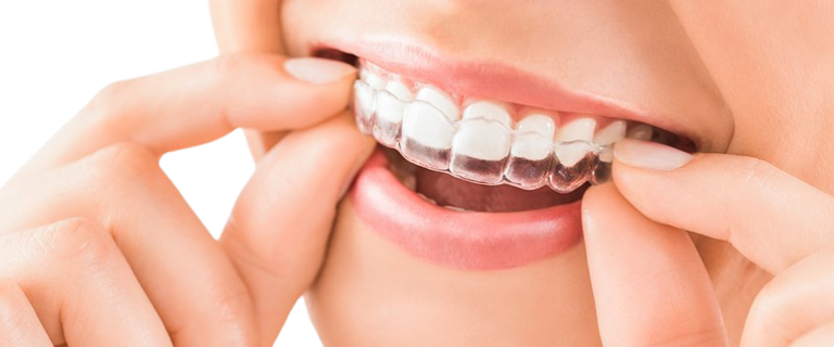 How to Ensure Successful Invisalign Treatment