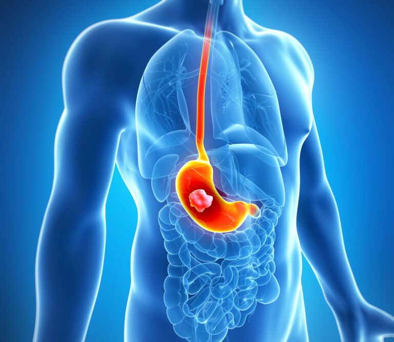 Pancreatic Cancer Stages: What They Mean for Treatment and Prognosis