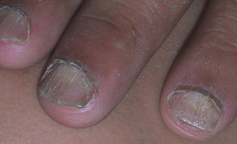 What Is A Nail Removal or Avulsion Procedure?