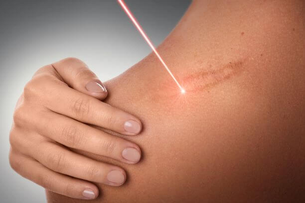 Everything You Need to Know About Laser Scar Removal