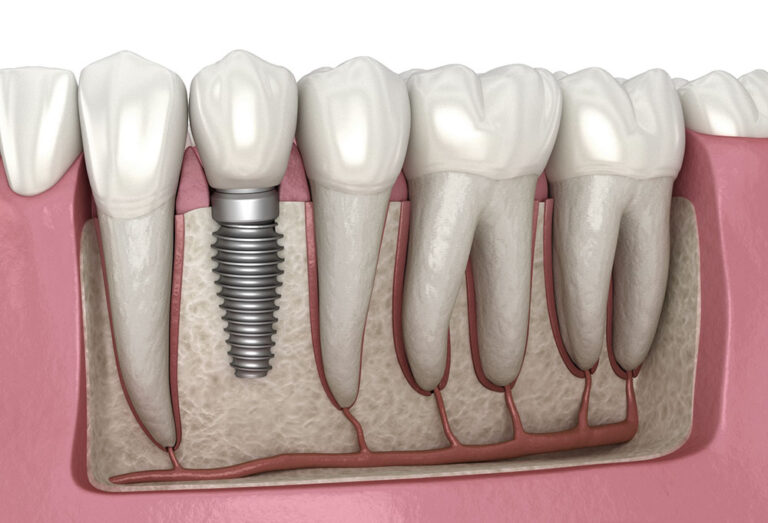 Are Sleep Apnea Dentists the Key to Successful Full Mouth Implants?