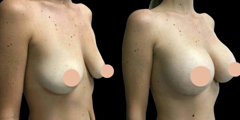 Before and after image of a female breast lift