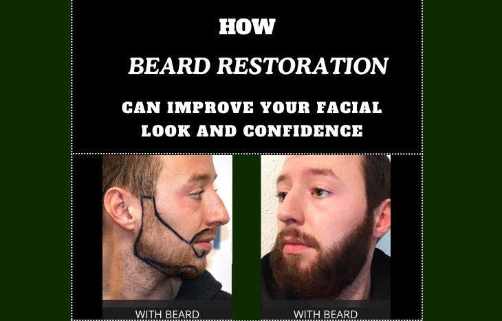 How-Beard-Restoration-Can-Improve-Your-Facial-Look-and-Confidence