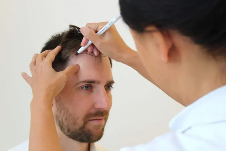 Why FUE Hair Transplant is Popular in London: Insights and Benefits