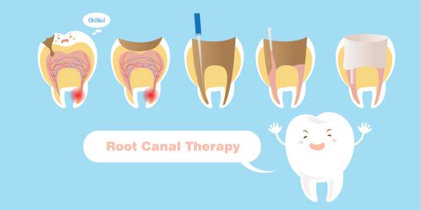 What to Know Before Getting a Root Canal Therapy in Adelaide