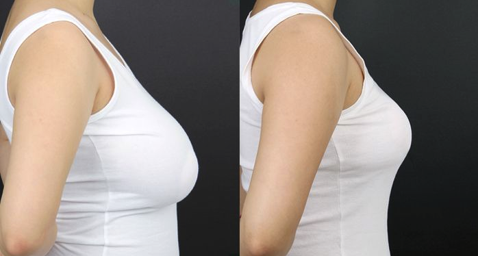 Periareolar vs. Anchor vs. Vertical Breast Lift: Understanding the Options in Dubai