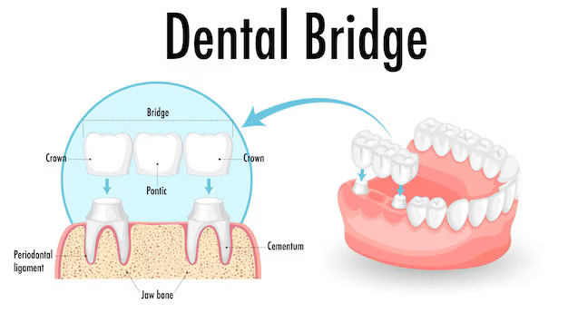 The Process Of Getting Crowns And Bridges: What To Expect During Your Dental Visits