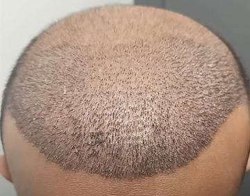 A full-head hair transplant